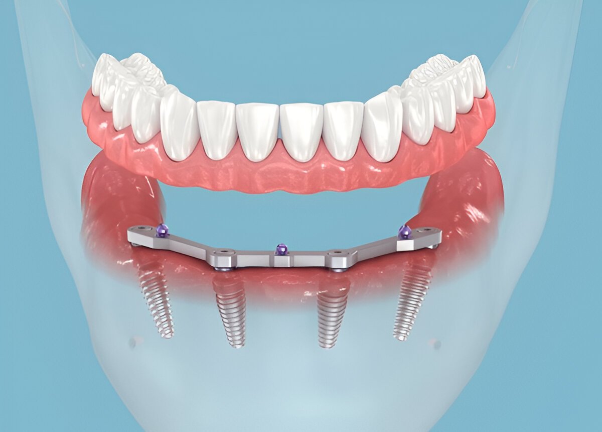 dental implants in brampton