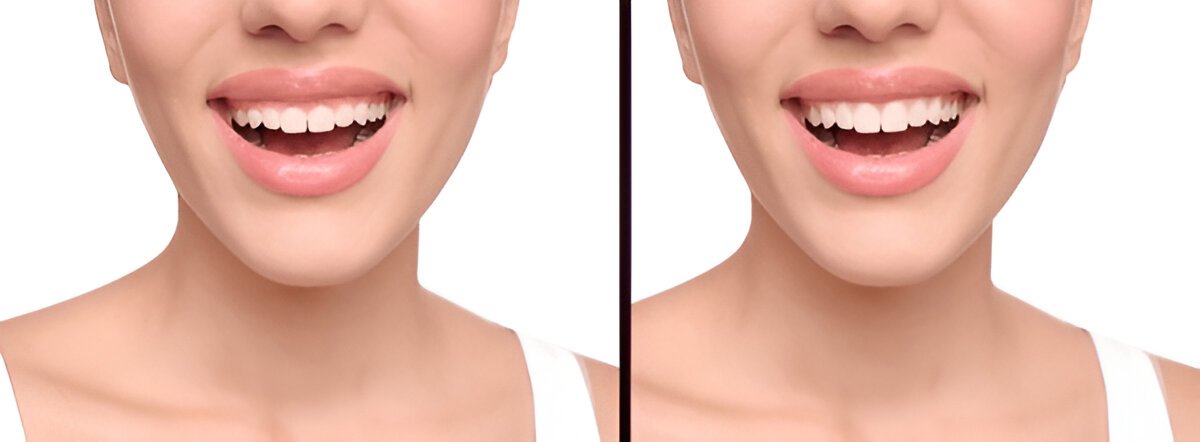 gum contouring in brampton