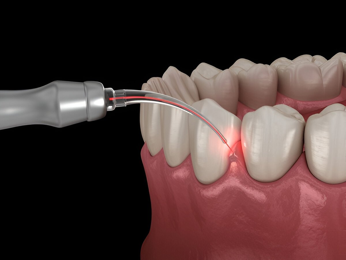gum surgery in brampton