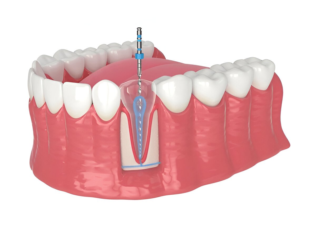 root canal treatment in brampton