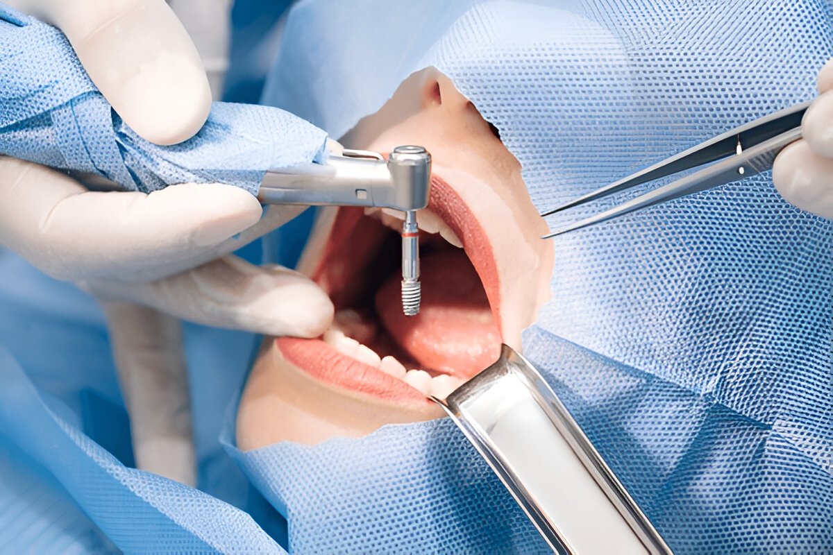 root canal treatment near you