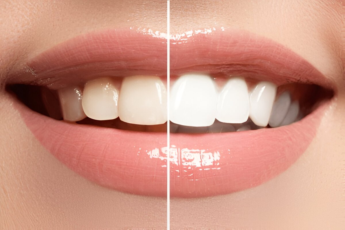 teeth whitening in brampton