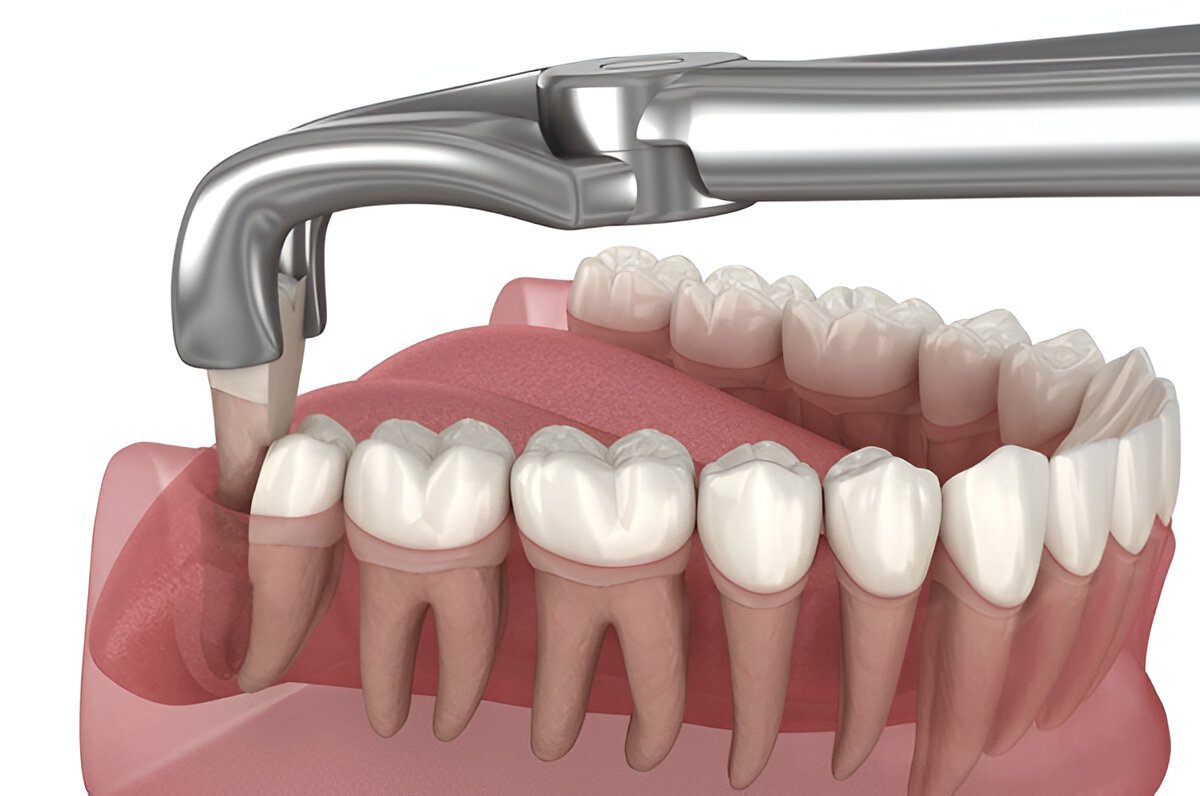 wisdom tooth extractions in brampton