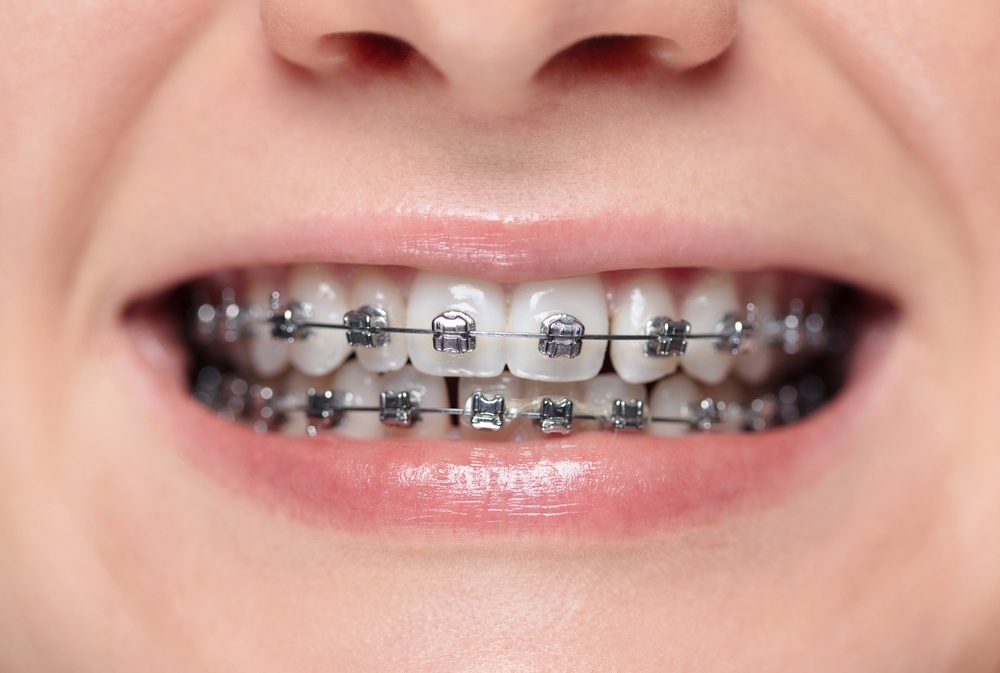 braces brampton