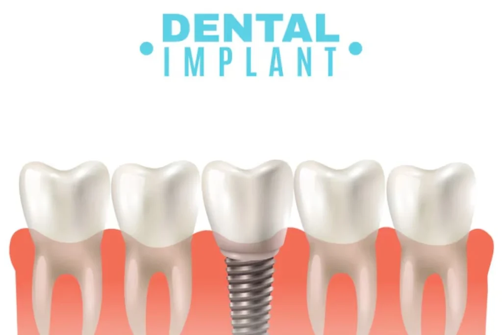 Dental Implant Replacing A Missing Tooth With A Natural-Looking Permanent Restoration