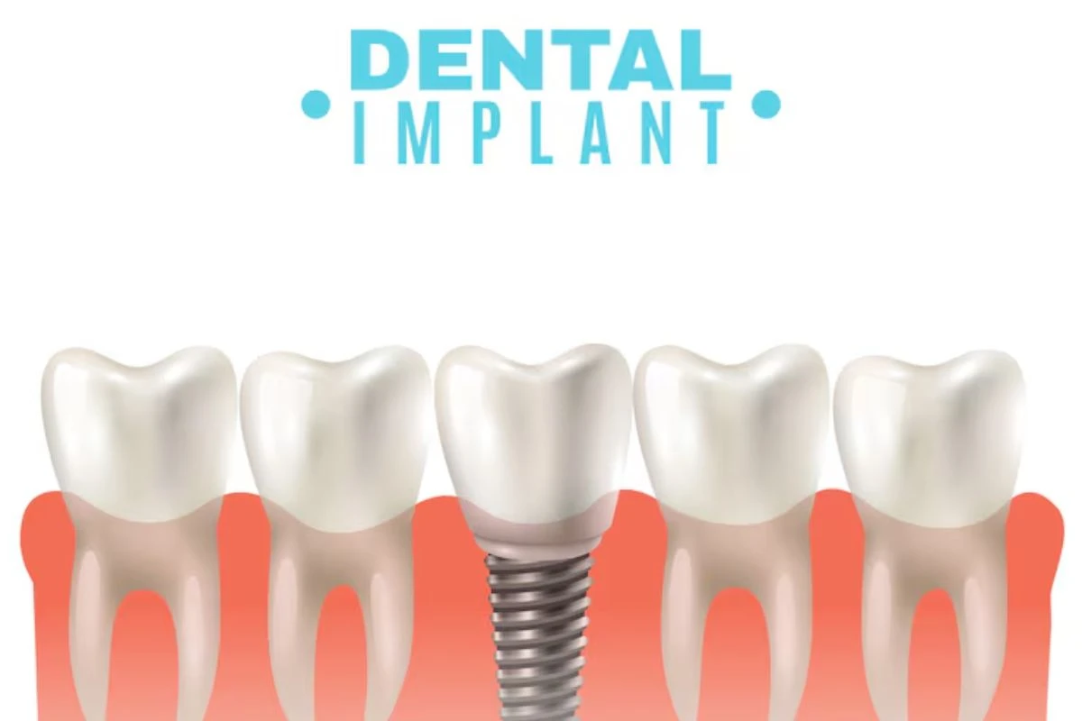 Dental Implant Replacing A Missing Tooth With A Natural-Looking Permanent Restoration