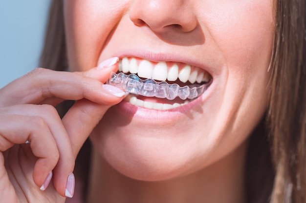 how to straighten your teeth without braces