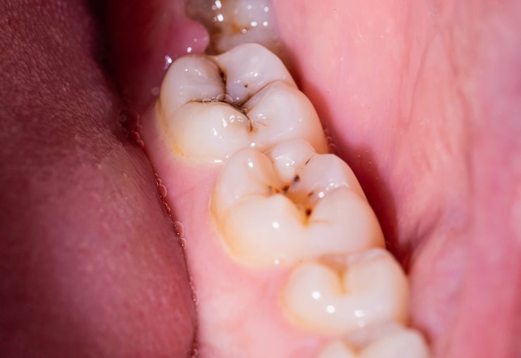 why do i keep getting cavities even though i brush every day?